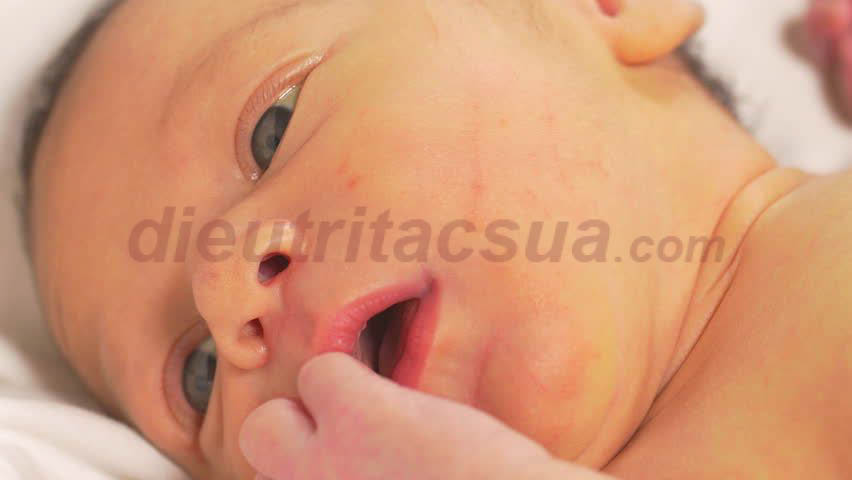 Các bé bị nhiễm trùng sơ sinh hoặc sinh non dễ bị bệnh vàng da 